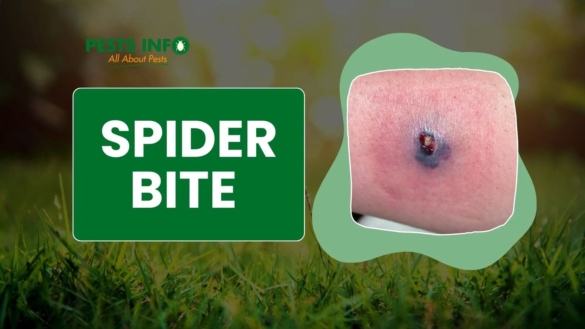 Why You Should NEVER Squeeze Pus from a Spider Bite